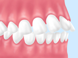 上顎前突/じょうがくぜんとつ
