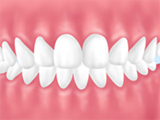 上下顎前突/じょうげがくぜんとつ