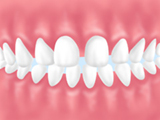 空隙歯列/くうげきしれつ